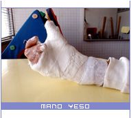 Mano de Yeso